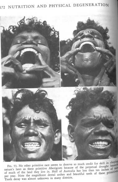 Healthy Aboriginies with Straight Teeth without Tooth Decay