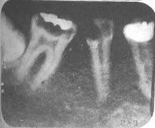 Tooth Cavity X-ray
