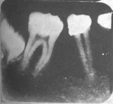 X-ray showing Enamel Growth in Tooth