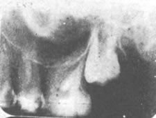 Tooth Cavity X-ray