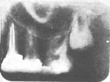 X-ray showing enamel growth