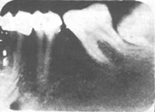 X-ray showing enamel Growth in Teeth