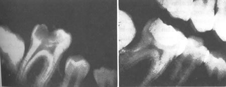 Before and After Cavity in Teeth Healing